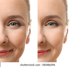 Mature woman face before and after cosmetic procedure. Plastic surgery concept.