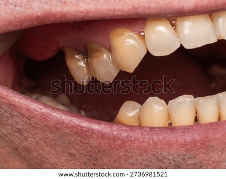 Maxillary 4th and 5th teeth, previously filled, show plaque, caries and non‑carious cervical lesions with wedge‑shaped defects at the cervical area near the necks of the teeth