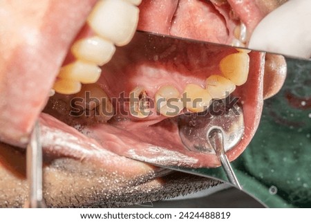 Maxillary arch with decayed premolar crown half destroyed, remaining root canal cavity in endodontics treatment. Indirect mirror reflexion view and lip retracted with metallic dental mirror instrument