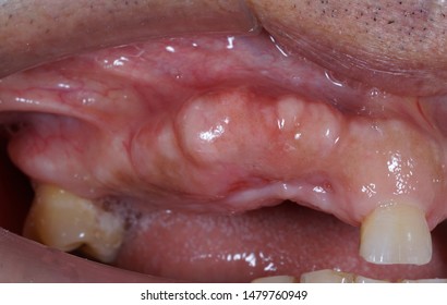 Maxillary Bone Exostosis On Labial Surface