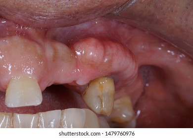 Maxillary Bone Exostosis On Labial Surface