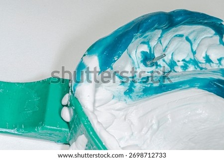 Maxillary dental arch impression using a double mixture of heavy white silicone and relined light blue material, showing a premolar with a metallic root post prepared for a post and core restoration.