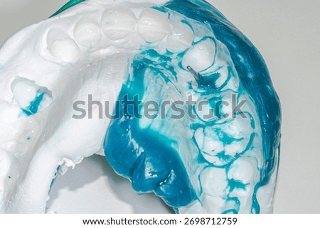 Maxillary dental arch impression using a double mixture of heavy white silicone and relined light blue material, showing a premolar with a metallic root post prepared for a post and core restoration.