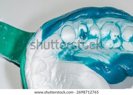 Maxillary dental arch impression using a double mixture of heavy white silicone and relined light blue material, showing a premolar with a metallic root post prepared for a post and core restoration.