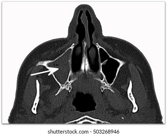 Maxillary Sinusitis
Maxillary Sinusitis Marked By Arrow On Computed Tomography