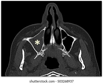 Maxillary Sinusitis Marked By Asterisk On Computed Tomography