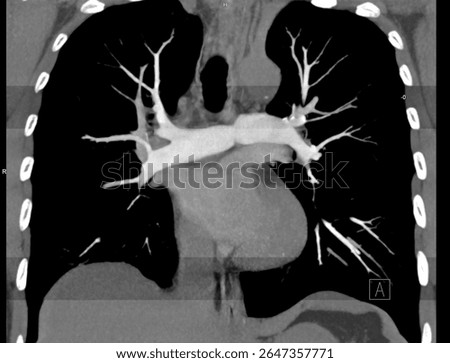 Maximum intensity projection (MIP) image from a CT angiography scan highlighting the pulmonary arteries and their branches with enhanced contrast.