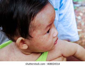 Measles In Baby