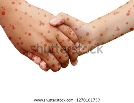 Measles disease concept and viral illness as a contagious chickenpox or a skin rash.