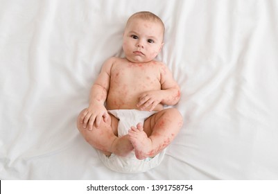 Measles. Upset Newborn Baby Suffering From Viral Disease Rash, Lying On Bed, Top View