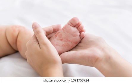 Measles Virus. Mother Holding Tiny Baby Foot With Red Rash, Closeup