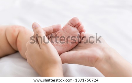 Measles virus. Mother holding tiny baby foot with red rash, closeup