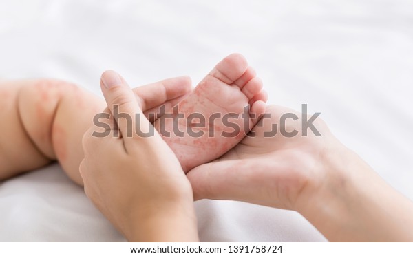 はしかウイルス 赤い発疹を持つ小さな赤ちゃんの足を持つ母親 接写 の写真素材 今すぐ編集