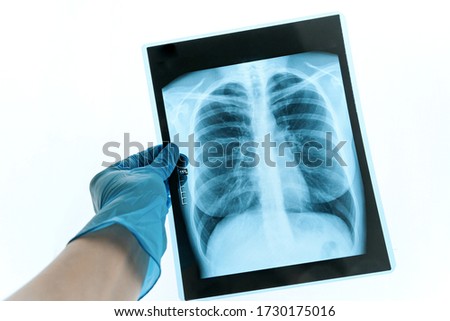 Medical doctor looking at x-ray picture of lungs in hospital. Covid-19 consept