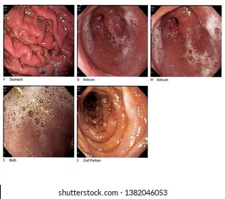 Medical image Gastrointestinal endoscopic examination image.Showing in side abdomonal body. - Shutterstock ID 1382046053