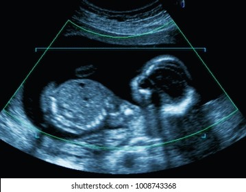 Medical image of mother's womb ultrasound during pregnancy.