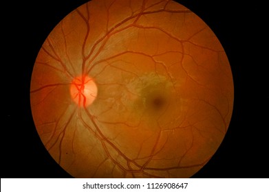 Medical Image Of Ocular Fundus, Human Retina