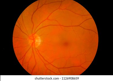 Medical Image Of Ocular Fundus, Human Retina