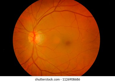 Medical Image Of Ocular Fundus, Human Retina