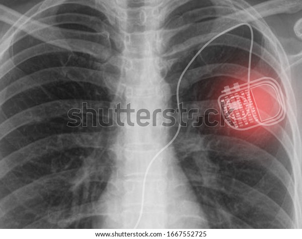 medical image of pacemaker implantation\
cardioverter defibrillator in chest\'s\
patient.