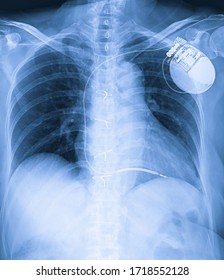 Medical Image Of Single Chamber  Implantation Cardioverter Defibrillator In Status Post Open Heart Surgery Patient.