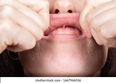 Medical inspection of the superior labial frenulum to evaluate the need for frenectomy oral surgery