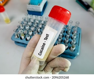 Medical laboratory urine container with urine sample for drugs test Cocaine. Diagnosis of illegal drug Cocaine in urine.