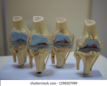 Medical Model Of Knee Joint Showing Multiple Stage Of Knee Osteoarthritis. Joint Erosion. Cartilage Loss. Osteophyte.