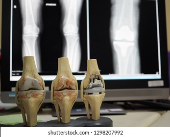 Medical Model Knee Joint Showing Multiple Stock Photo (Edit Now) 1298207992