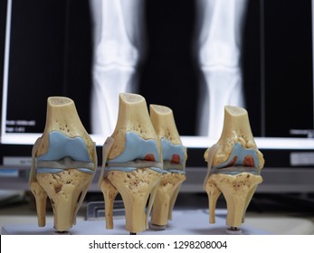 Medical Model Of Knee Joint Showing Multiple Stage Of Knee Osteoarthritis. Knee Joint X-ray On The Background. Cartilage Loss. Osteophyte. Subchondral Bone Sclerosis.