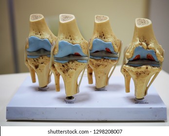 Medical Model Of Knee Joint Showing Multiple Stage Of Knee Osteoarthritis. Total Knee Replacement. TKA TKR 