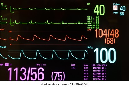 Medical Monitor Bradycardia Normal Blood Pressure Stock Photo ...