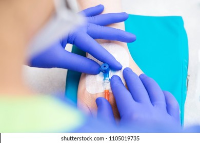 medical nurse with blue latex gloves inputs catheter to vein patient for drip of chemotherapy or another liquid medicine from cancer