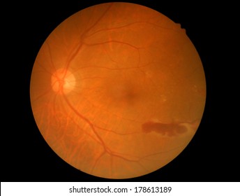 Medical Photo Diabetic Retinopathy Symptoms Vitreous Haemorrhage 