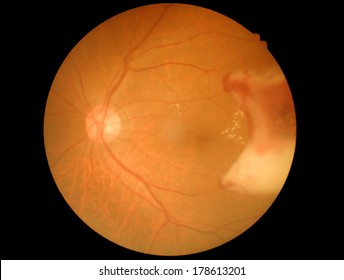 Medical Photo Diabetic Retinopathy Symptoms Vitreous Haemorrhage 