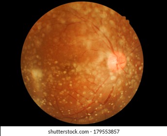 Medical Photo Retina Detail And Vitreous