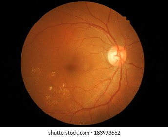 Medical Photo Retina Of Diabetic - Exudate 