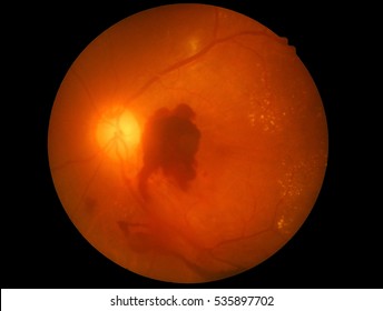 Medical photo retina diabetic retinopathy