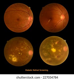 Medical photo retinopathy (eye screen) diabetes retinal screening