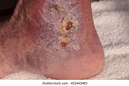 Medical picture: Infection cellulitis on the skin of an ankle caused by phlebitis and blood clots in the vein. 