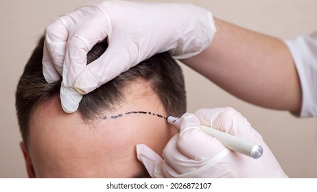 medical professional with gloves draws a dotted line on the head of a balding man. - Shutterstock ID 2026872107