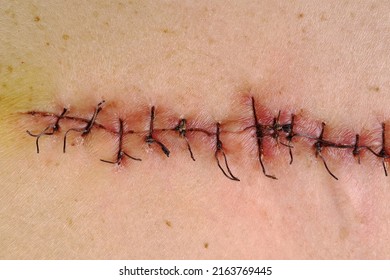 Medical sutures, stitches after surgery, stitched surgical sutures on human body. Medical surgical care. Close-up.