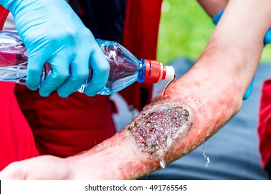 Medical Worker Treating Burns On Male's Hand. First Aid Treatment Outdoors. First Aid Practice