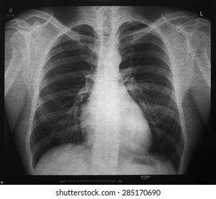 Medical X-ray featuring male chest. Black and white image. Lower neck and shoulders can be seen with lungs and ribcage. 