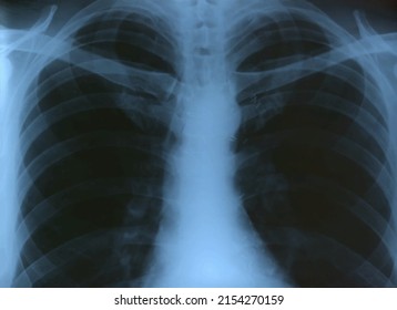 Medical X-Ray Image Of Human Chest MRI For Diagnosis Of Diseases