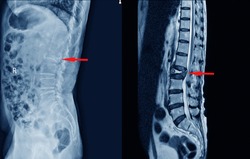 Medical X-ray And MRI Of Lumbar Spine Compression Fracture Bulging Of L1-2. On Arrow Point..Lumbar Spondylosis From L1-2 To L5-S1 Discs.Medical Healthcare Concept.