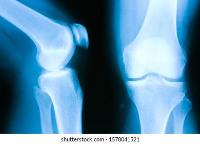 Medical Xray Picture Of A Knee