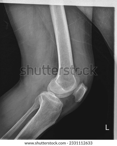Medical X-ray: Skeletal knee joint 