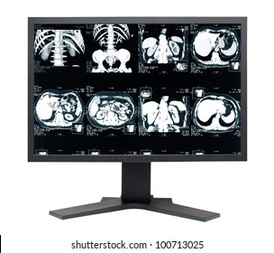 Medicalmonitor. MRI Tomogram Of Human Kidney