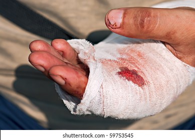 Medicine Bandage With Blood On Human Injury Hand After Accident With Chainsaw